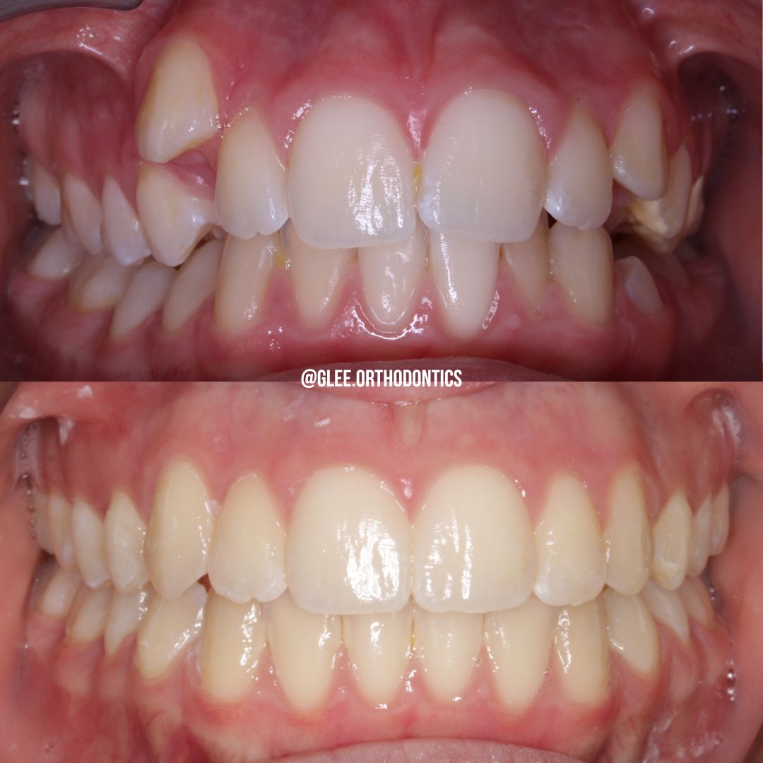 Before and after — ectopic canine and severe crowding corrected with clear aligners