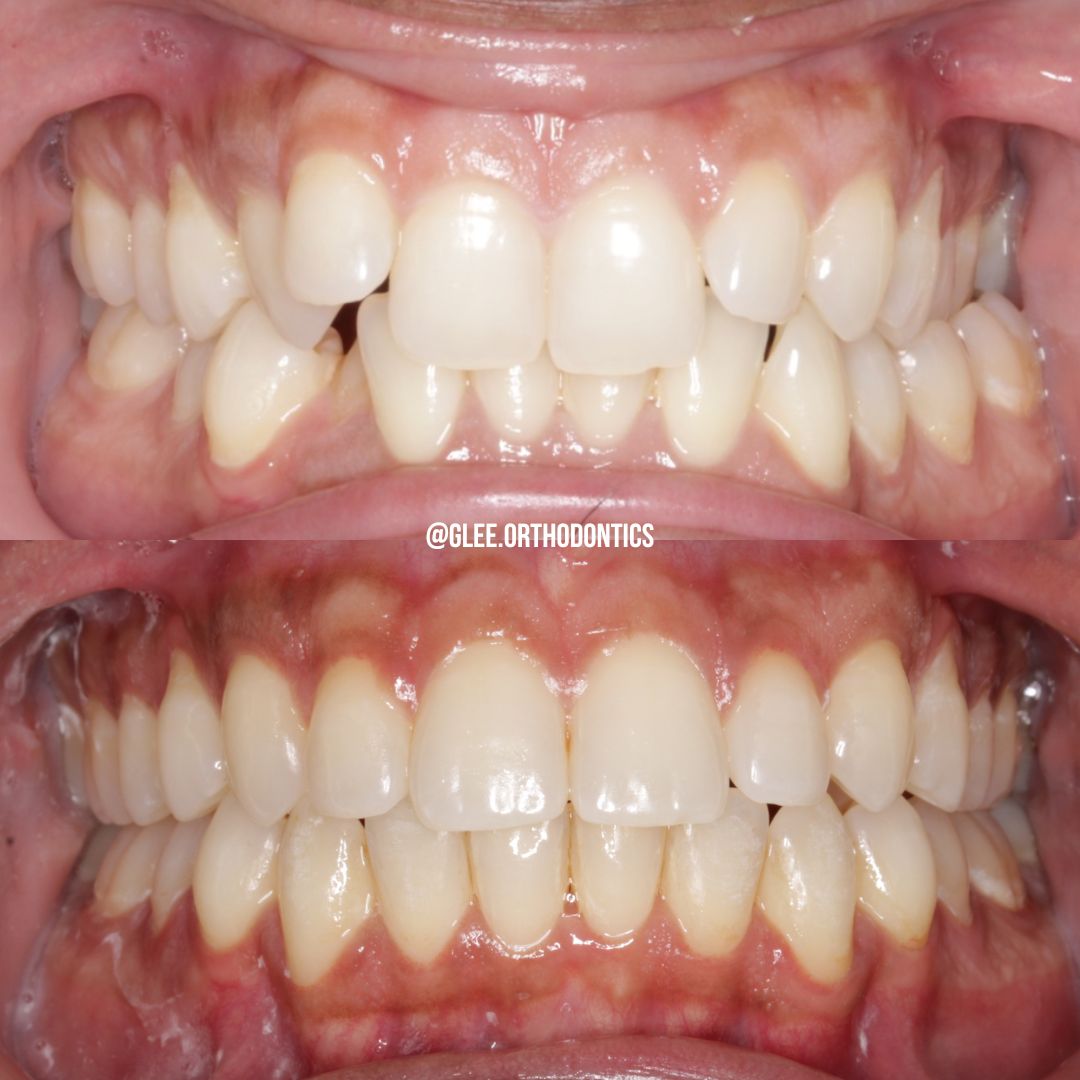 Before and after — adult crowding corrected with clear aligners