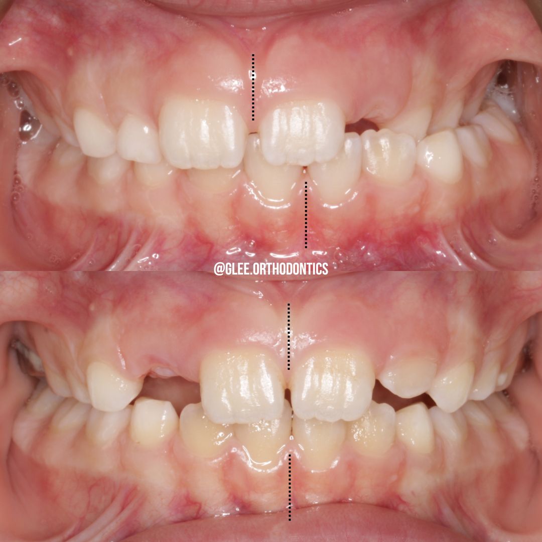 Before and after — early Phase I treatment with a palatal expander in a child