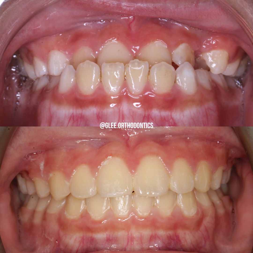 Before and after — two-phase growth guidance with facemask and braces