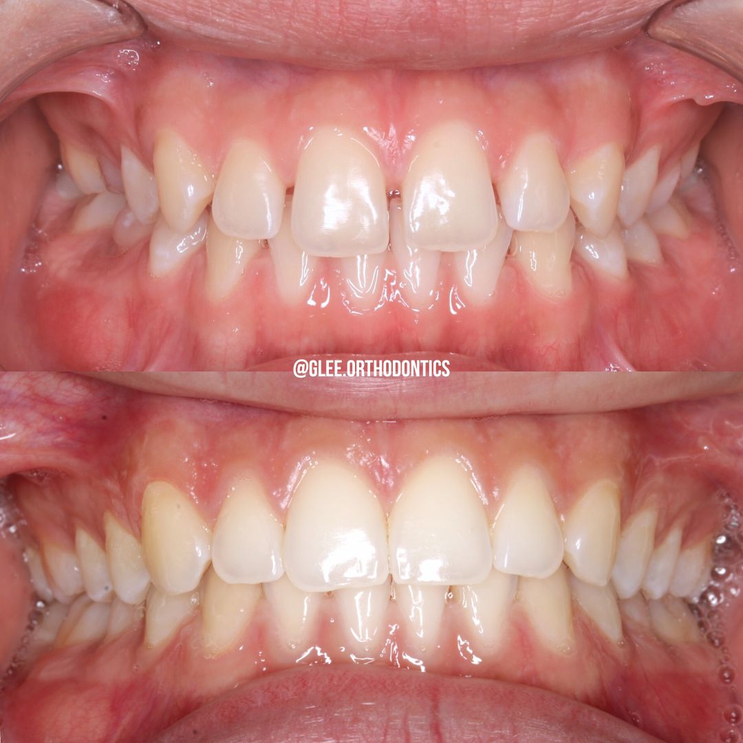 Before and after — diastema closed and overbite corrected with braces