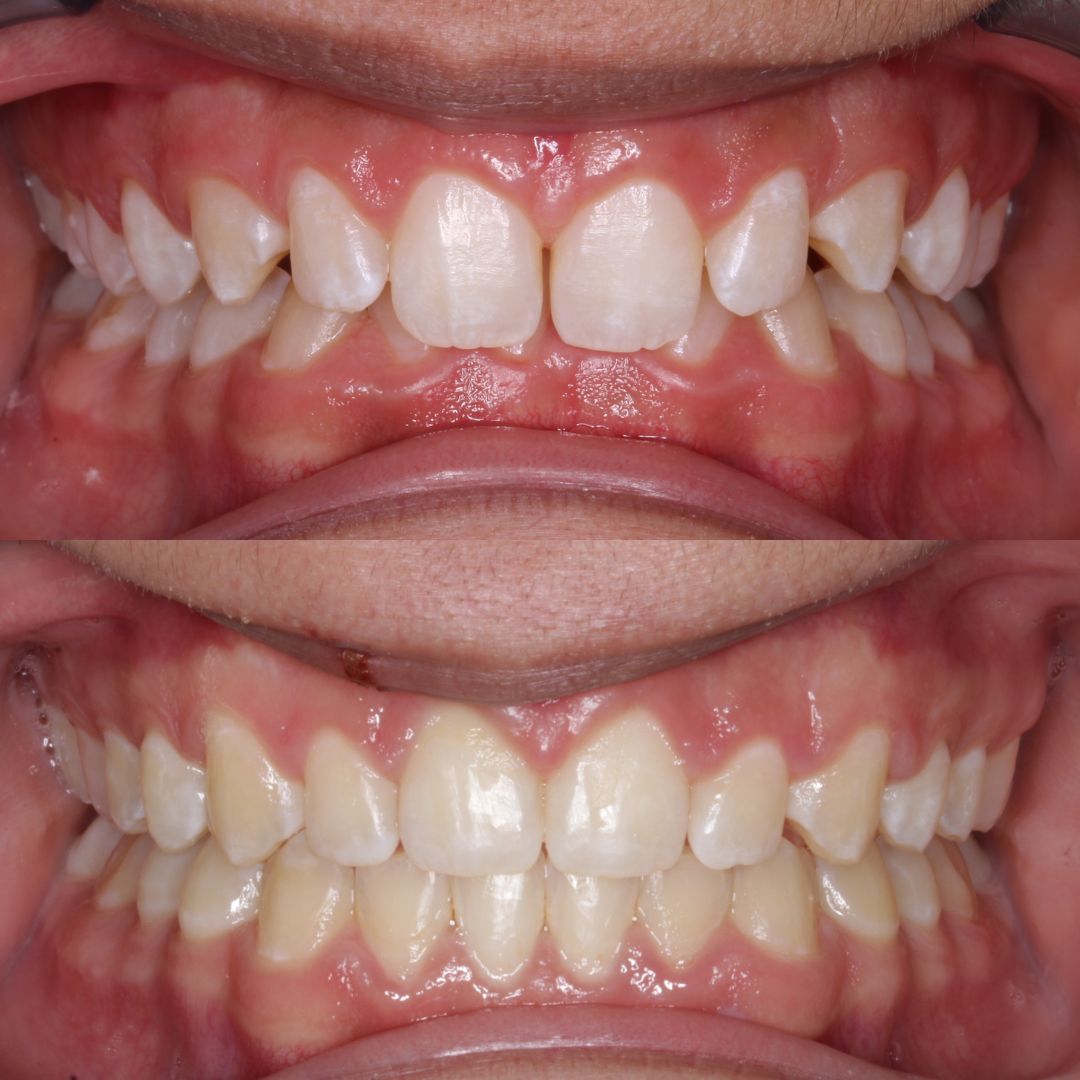 Before and after — spaces closed and overbite corrected with braces