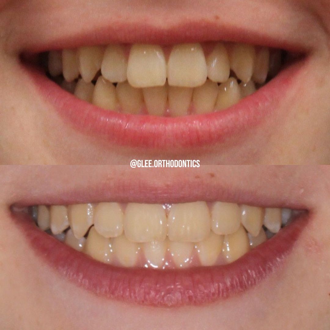 Before and after — broader, fuller smile after arch expansion with clear aligners
