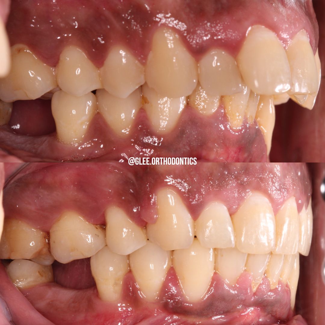 Before and after — overjet and deep bite corrected with braces and premolar extraction